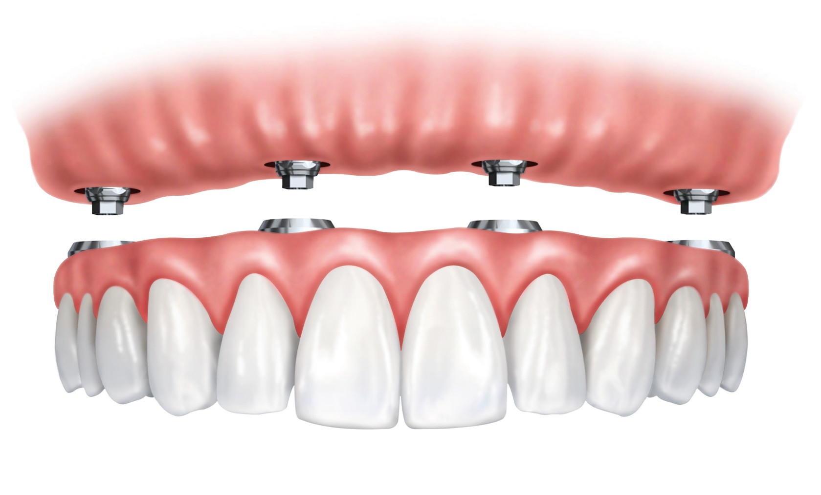 Viso žandikaulio dantų atkūrimas naudojant tik 4 implantus.