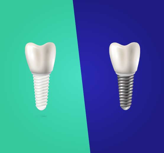  Iškrito dantis: nieko nedaryti ar sriegti dantų implantą?