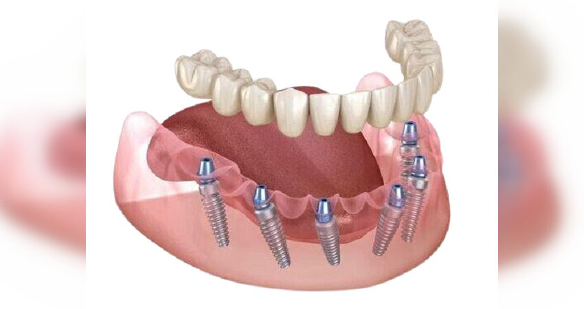  Įdomūs ir mažiau girdėti faktai apie keraminius dantų implantus