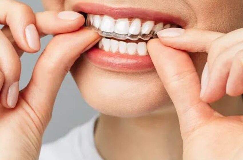 dantų tiesinimo kapos