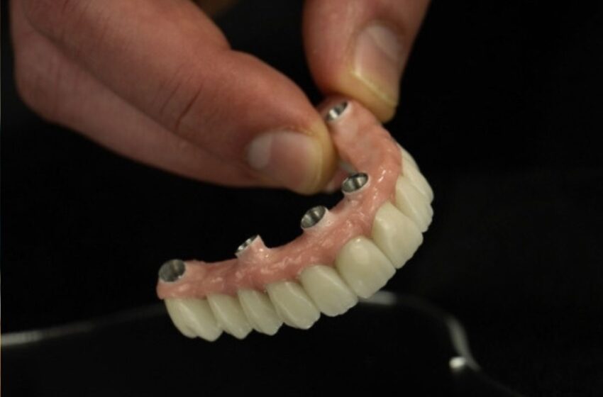  Bedančių žandikaulių atkūrimas „visi dantys ant 4 implantų“ metodika – gydymo privalumai